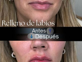 Relleno de labios antes y después - 875787