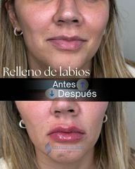 Rellenos de Labios - Dr. Rodolfo Villavicencio