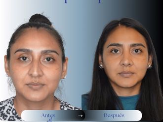 Rinoplastia antes y después - 875966