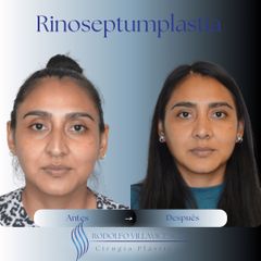 Rinoplastia - Dr. Rodolfo Villavicencio