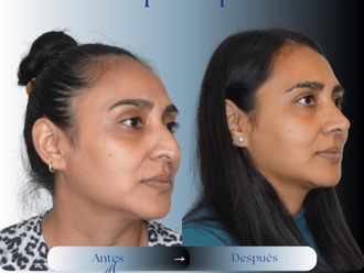 Rinoplastia antes y después - 875967