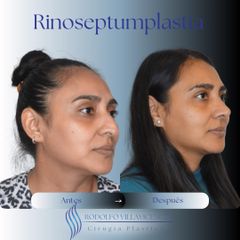 Rinoplastia - Dr. Rodolfo Villavicencio