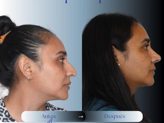 Rinoplastia antes y después - 875968