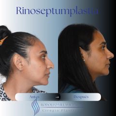 Rinoplastia - Dr. Rodolfo Villavicencio