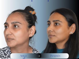 Rinoplastia antes y después - 875969