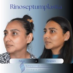 Rinoplastia -Dr. Rodolfo Villavicencio