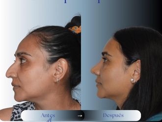 Rinoplastia antes y después - 875970