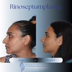 Rinoplastia - Dr. Rodolfo Villavicencio