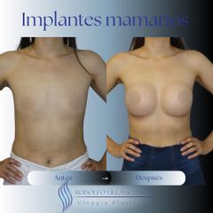 Aumento Mamas -Dr. Rodolfo Villavicencio