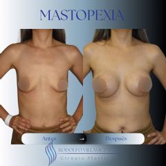 Mastopexia - Dr. Rodolfo Villavicencio