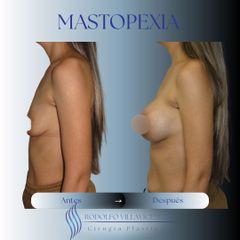 Mastopexia - Dr. Rodolfo Villavicencio
