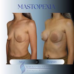 Mastopexia - Dr. Rodolfo Villavicencio