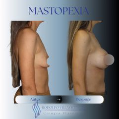 Mastopexia - Dr. Rodolfo Villavicencio