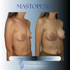 Mastopexia - Dr. Rodolfo Villavicencio