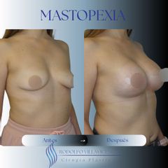 Mastopexia - Dr. Rodolfo Villavicencio