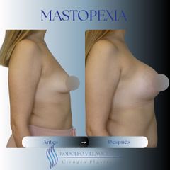 Mastopexia - Dr. Rodolfo Villavicencio