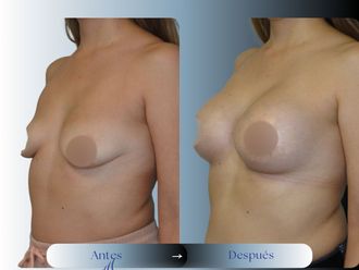 Mastopexia antes y después - 876415