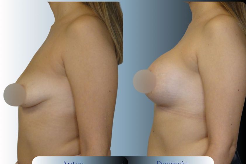 Mastopexia antes y después - 876416