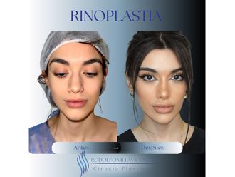 Rinoplastia antes y después - 879044