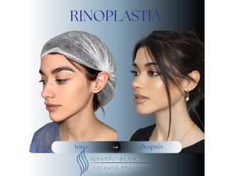 Rinoplastia antes y después - 879045