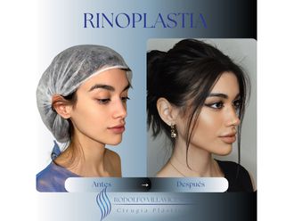Rinoplastia antes y después - 879046