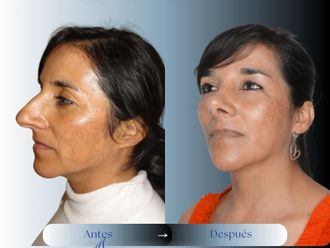 Rinoplastia antes y después - 879726