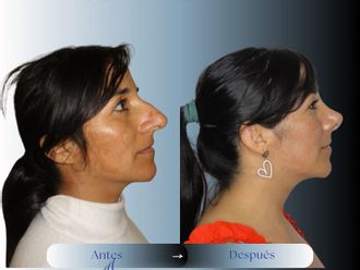 Rinoplastia antes y después - 879727