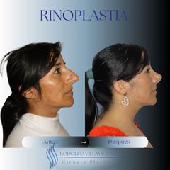 Dr. Rodolfo Villavicencio - Rinoplastia