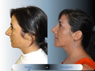 Rinoplastia antes y después - 879728