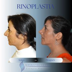 Dr. Rodolfo Villavicencio - Rinoplastia