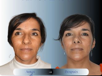 Rinoplastia antes y después - 879729