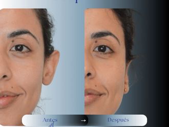 Otoplastia antes y después - 879815