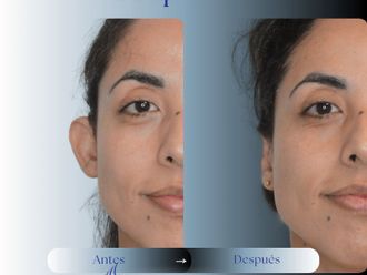 Otoplastia antes y después - 879816