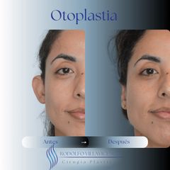 Otoplastia - Dr. Rodolfo Villavicencio