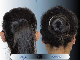 Otoplastia antes y después - 879817