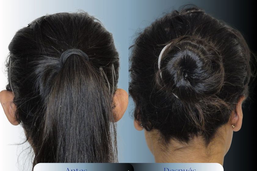 Otoplastia antes y después - 879817