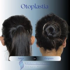 Otoplastia - Dr. Rodolfo Villavicencio