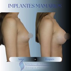 Aumento Mamas - Dr. Rodolfo Villavicencio