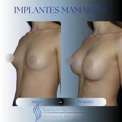 Aumento Mamas - Dr. Rodolfo Villavicencio