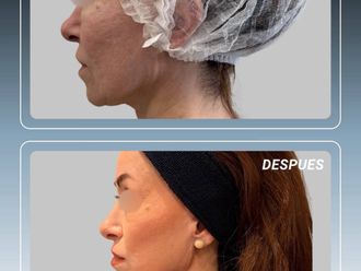 Lifting antes y después - 880578