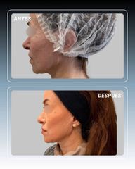 Endolifting Lifting sin cirugia - Dr. Rodolfo Villavicencio