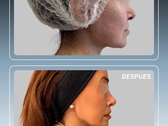 Lifting antes y después - 880580