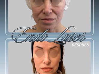 Lifting antes y después - 880581