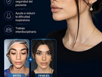 Rinoplastia antes y después - 880638