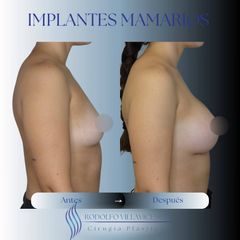 Implantes mamarios . Dr. Rodolfo Villavicencio