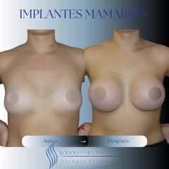 Implantes mamarios - Dr. Rodolfo Villavicencio