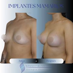 Implantes mamarios - Dr. Rodolfo Villavicencio