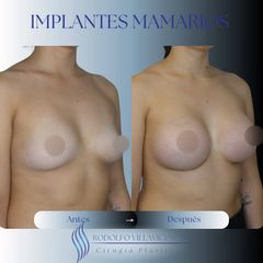 Implantes mamarios - Dr. Rodolfo Villavicencio
