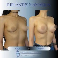 Aumento Mamas - Dr. Rodolfo Villavicencio