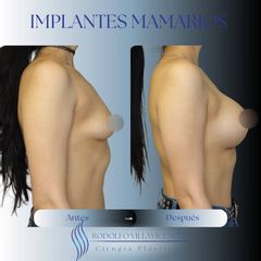 Aumento Mamas - Dr. Rodolfo Villavicencio